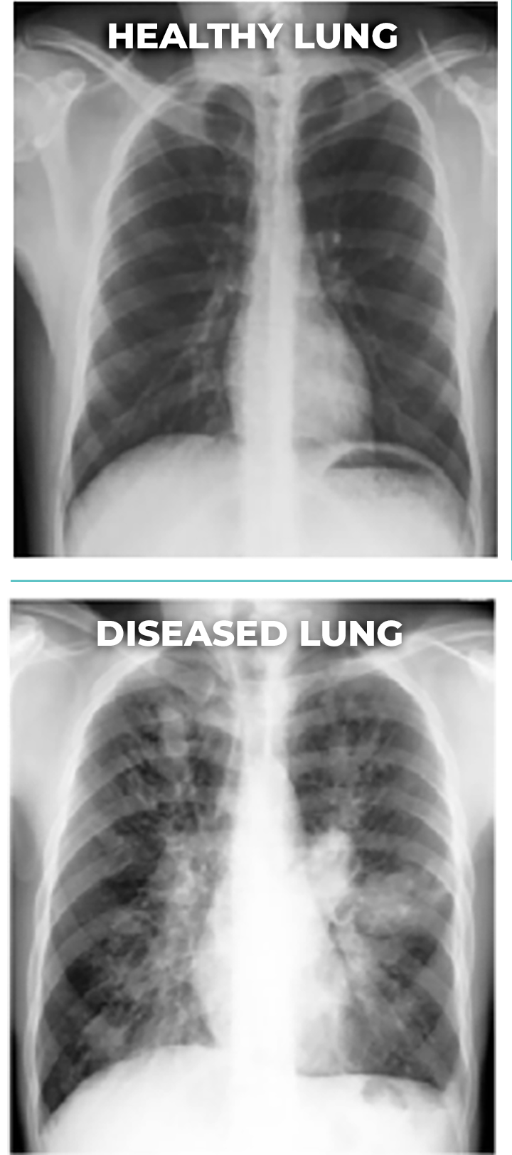 ABPA Lung